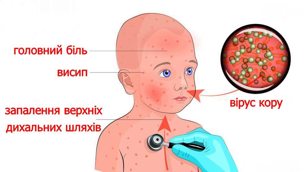 Основні питання щодо кору